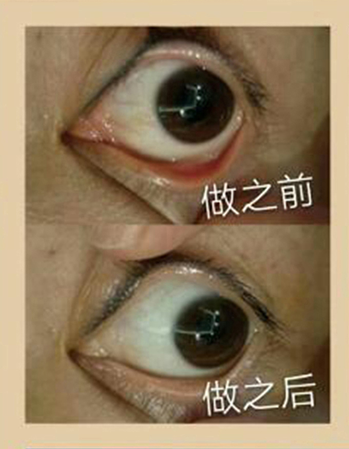 眼球抗衰前后对比