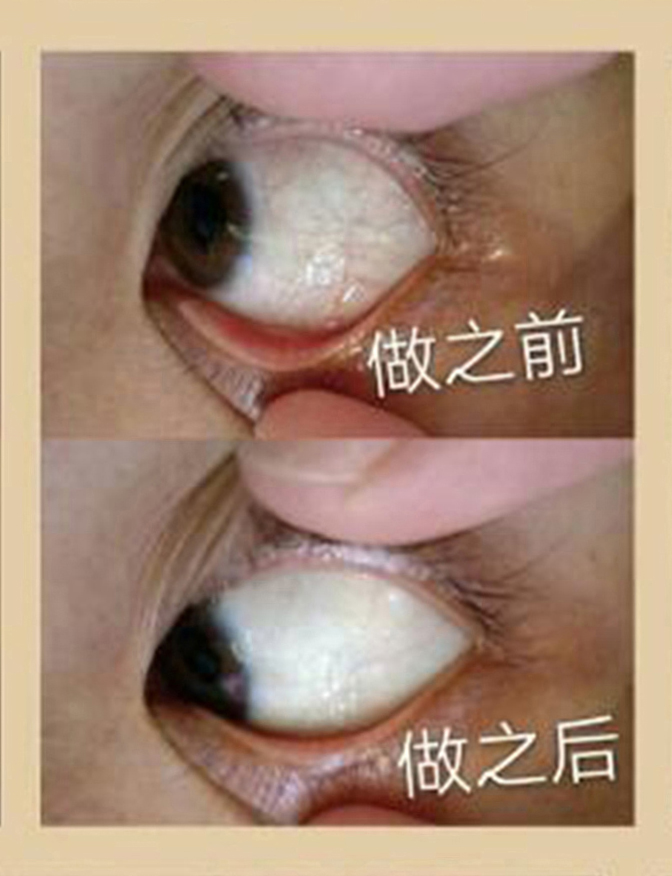 眼球抗衰对比案例