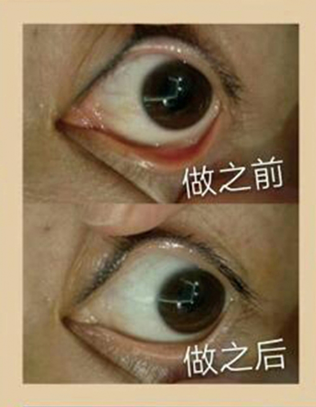 眼球抗衰前后对比