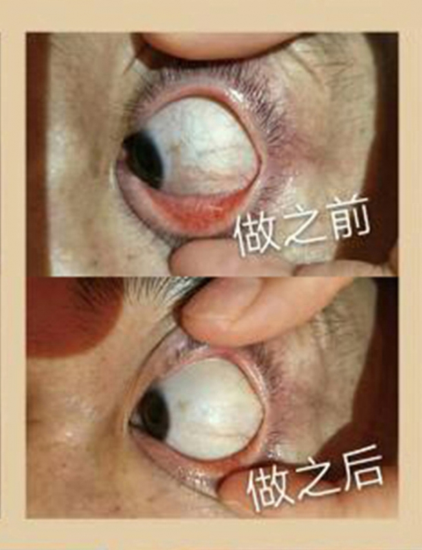 眼球抗衰前后对比案例