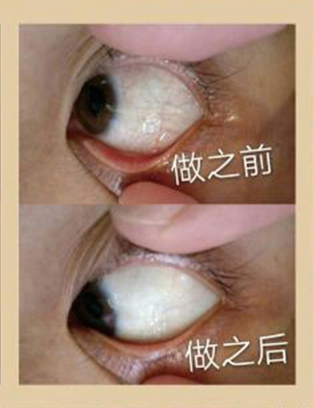 眼球抗衰对比案例