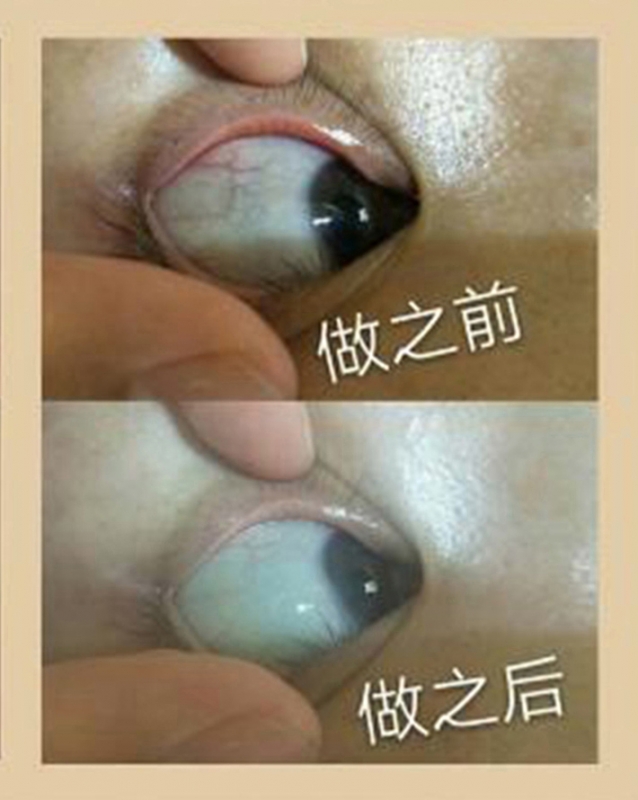 眼球抗衰前后对比