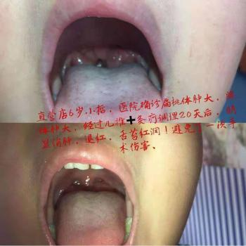 艾童灸法7