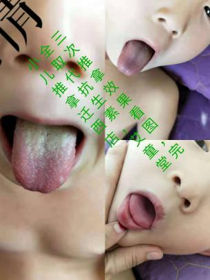 艾童灸法9